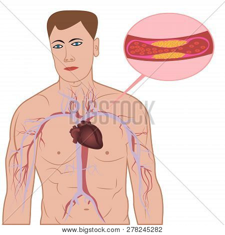 Levels Of Cholesterol Plaque In Vessels Vector Illustration