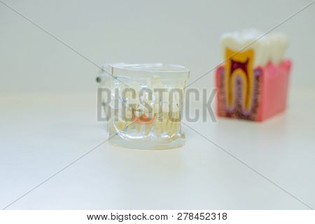 Teeth And Dental Mirror, Symbol Photo Of Dentures, Diagnosis And Copayment.tooth Model For Classroom