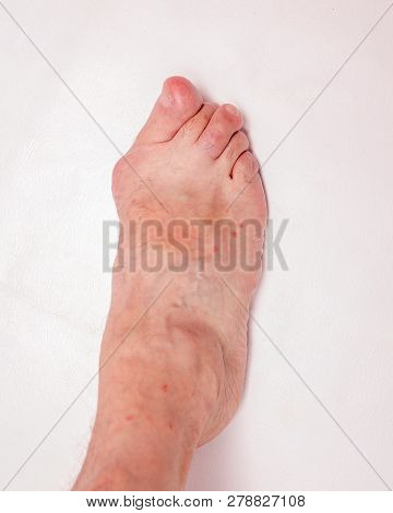 Hallux Abductus Valgus