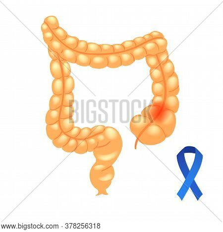 Realistic High Detailed Vector Illustration Of Colon With Cancer. Cancer Ribbon.