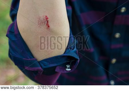 Injuries From Falling In The Garden.\na Man Showing A Lesion On His Arm. Arm Is Wound From A Knife. 