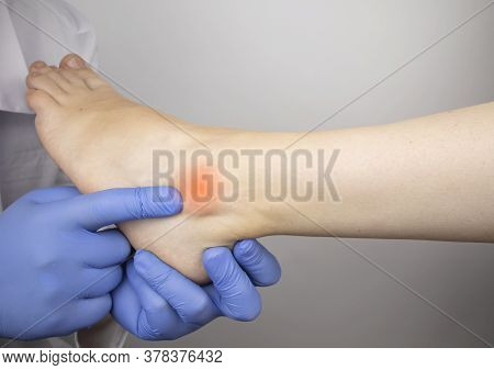 The Podiatrist Examines The Heel And Its Ridges In A Patient Who Complains Of Acute Pain. Suspected