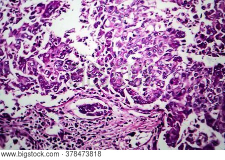 Breast Ductal Carcinoma, Light Micrograph, Photo Under Microscope