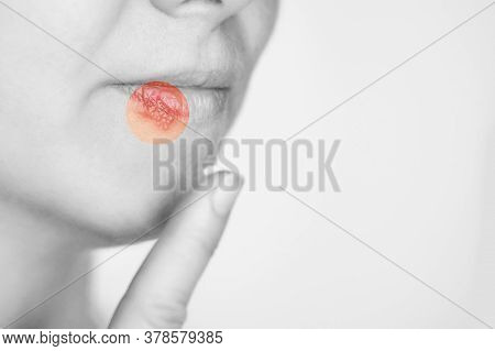 Girl With Herpes. Sick Mouth Symptom. Lips Cold. Red Round Concept. Finger Near Head. Woman Face. He