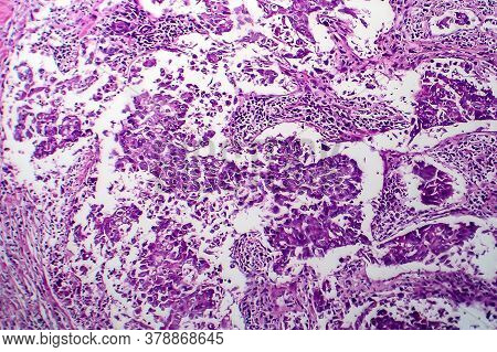 Breast Ductal Carcinoma, Light Micrograph, Photo Under Microscope