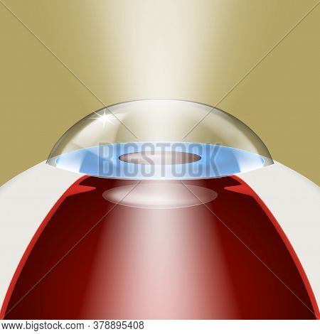 3d Intraocular Lens Implantation Model With Light