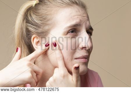 Caucasian Blond Female Girl Using Point Fingers For Pimples Squeezing Against Beige. Horizontal Imag