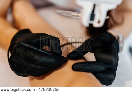 Doctor Is Doing Electroepilation To The Client, Using Electro Needle And Tweezers. Hair Removal Proc