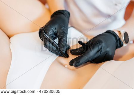Doctor Is Doing Electroepilation To The Client, Using Electro Needle And Tweezers. Hair Removal Proc