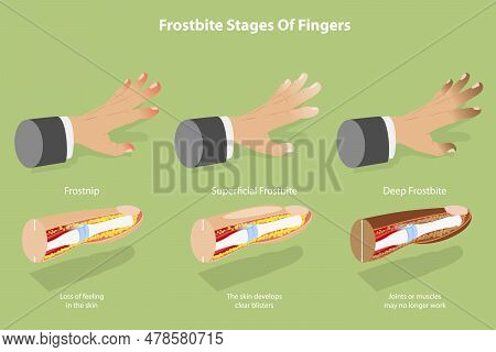 3d Isometric Flat Vector Conceptual Illustration Of Frostbite Stages Of Fingers, Frozen Hands