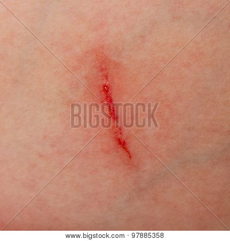 Close up a wound with blood on the skin