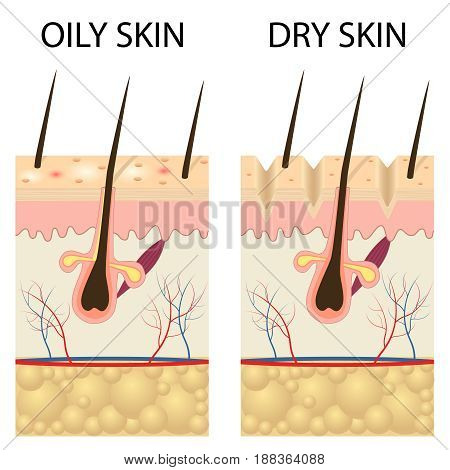 Human Skin types and conditions. Dry and oily. A diagrammatic sectional view of the skin.