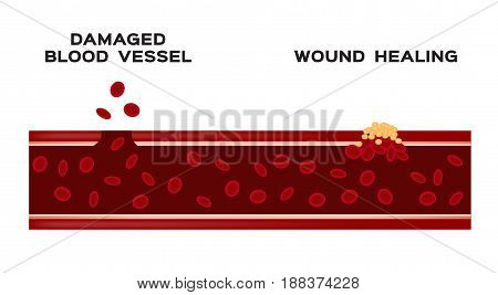 infographic of how blood vessel heal itself