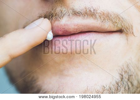 Herpes On Lips Of The Young Man. Man Smears Herpes With Herpes Cream