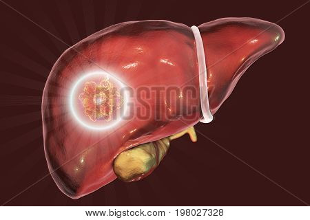 Liver cancer treatment. Conceptual image. 3D illustration