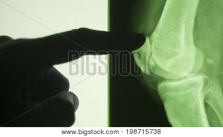 Knee Joint Xray Test Scan
