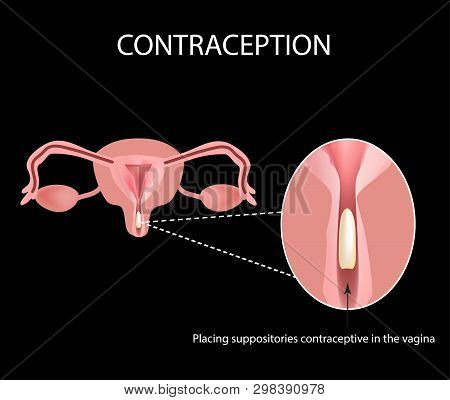 Contraceptives Suppositories. Infographics. Vector Illustration On A Black Background.