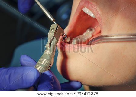 Dentist Is Taking Care About Patients Tooth Using Electric Dental Brush, Opening Patients Mouth Clos