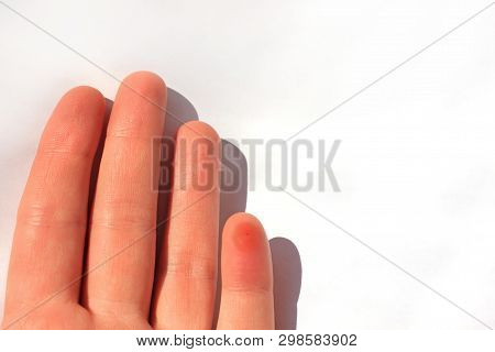 A Finger Stung By A Bee. Female Hand With An Insect Bite, Isolated On White Background, Copy Space.