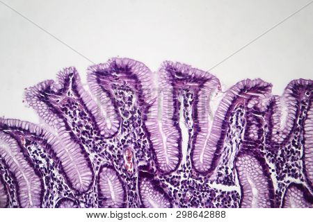 Histopathology Of Chronic Superficial Gastritis, Light Micrograph, Photo Under Microscope
