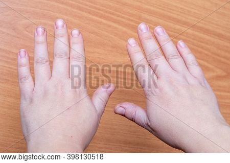 Close-up Of Female Hands With Natural Raw Dirty Nails On Wooden Background. Peeling On Nails. Hand A
