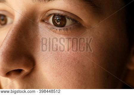 Portrait Of Girl Wound Bee Sting On Face Under Eye.swelling And Inflammation.