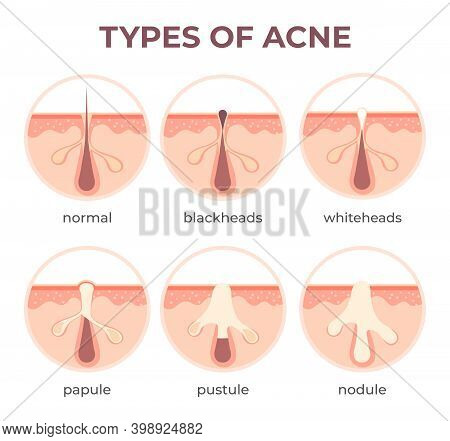 Acne Types Anatomy. Pimple Diseases Sectional View Blackhead, Cystic And Whitehead. Structure Of Ski