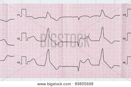 Tape Ecg With Macrofocal Myocardial Infarction And Ventricular Premature Beats