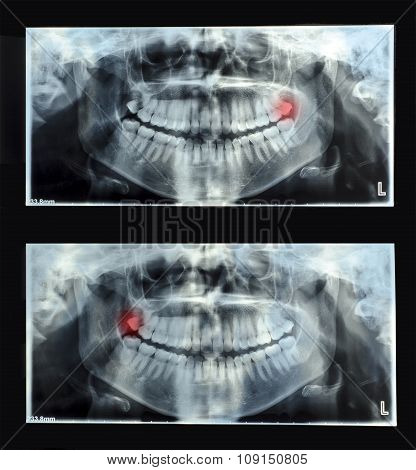 Panoramic Dental X-ray  With Superior Upper Wisdom Tooth (eight Tooth) Shown Red