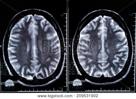 X-ray image of the brain computed tomography, imaging of the brain