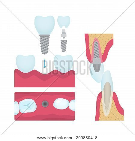 Set of dental crowns and implantation prosthodontics elements and tools. Vector flat illustration.