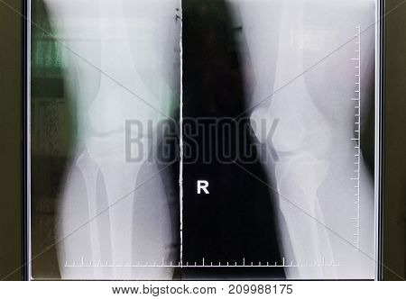 black and white Knee film X-ray .