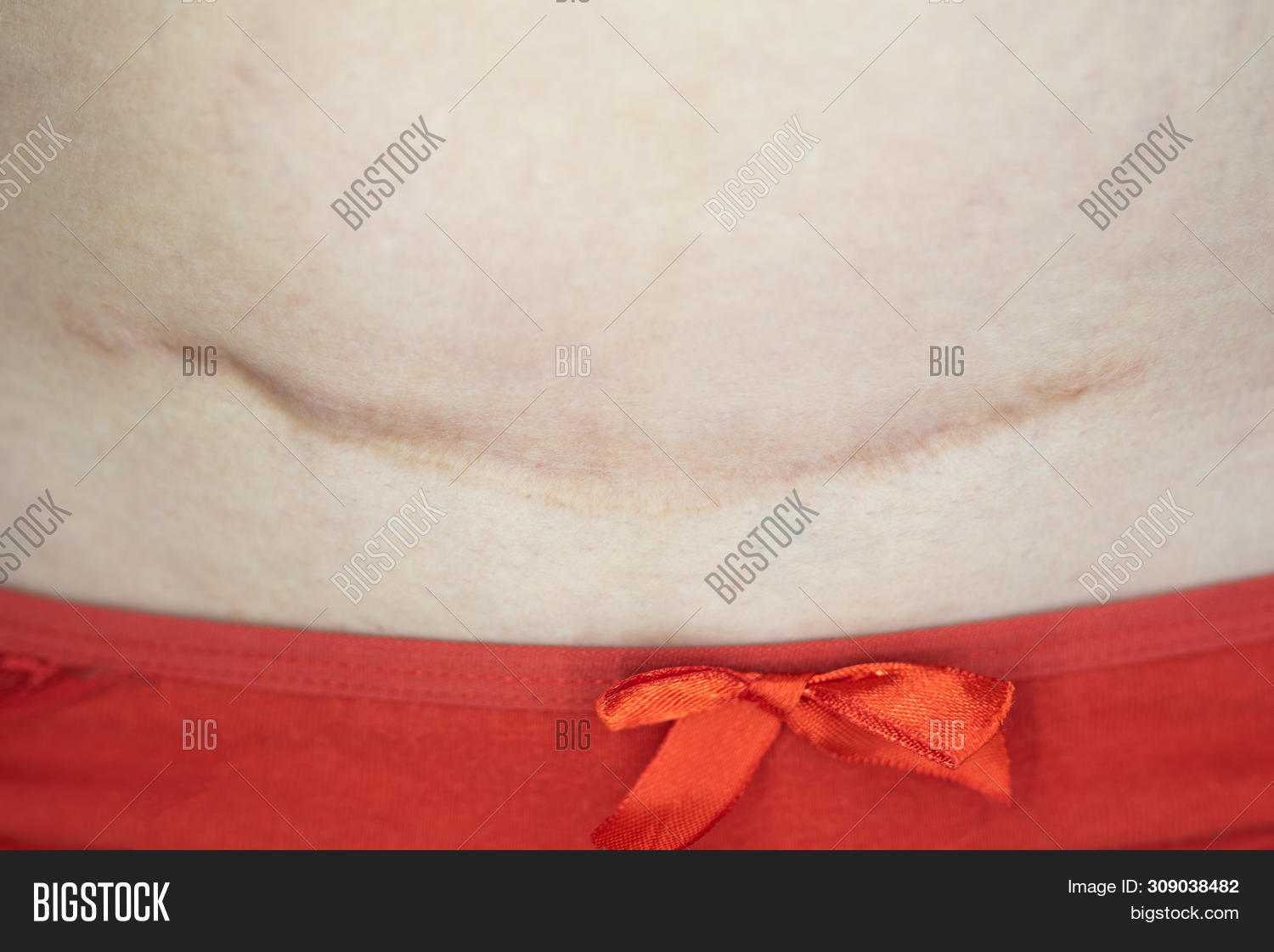 Scar On Abdomen Two C Image & Photo (Free Trial) Bigstock