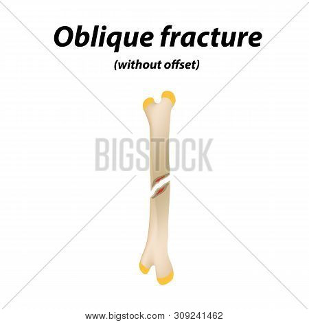 Oblique, Without Offset Bone Fracture. Infographics. Illustration On A Lined Background.