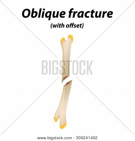 Oblique With Offset Bone Fracture. Infographics. Illustration On A Lined Background.