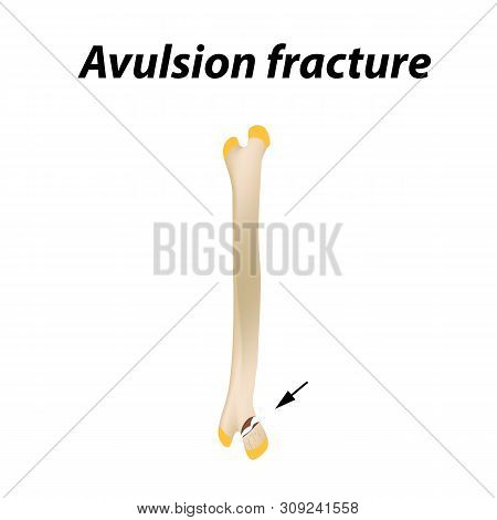 Avulsion Fracture Bone. Infographics. Illustration On A Lined Background.