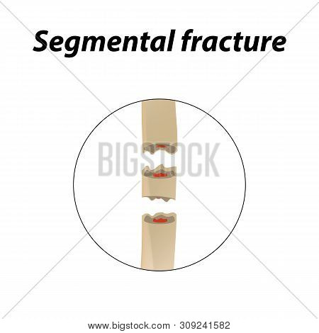 Segmental Fracture Bone. Infographics. Illustration On A Lined Background.