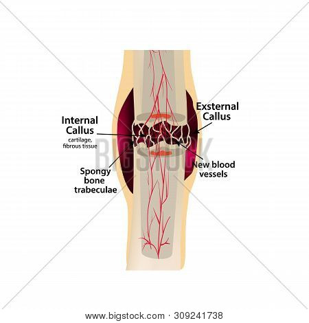 2 Stage Of Healing Bone Fracture. Formation Of Callus. The Bone Fracture. Infographics. Illustration