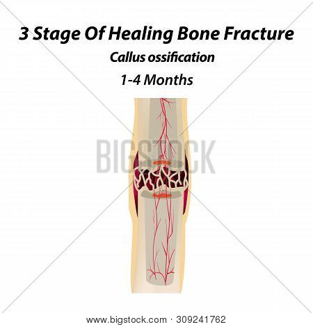 3 Stage Of Healing Bone Fracture. Callus Ossification. The Bone Fracture. Infographics. Illustration