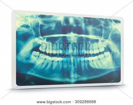 Woman X-ray Of The Teeth Wisdom Teeth Horizontal Pozition Problem Dentistry Medicine. Panoramic Imag
