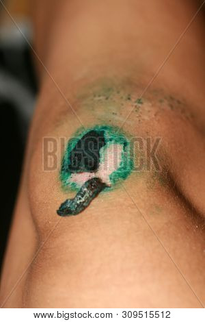 Healing Wound On The Knee. The Wound Treated With Brilliant Green. The Scab Will Climb