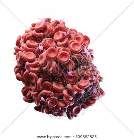 3d rendered medically accurate illustration of a blood clot
