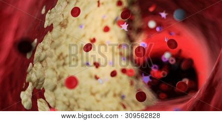 3d rendered medically accurate illustration of a capped plaque in a human artery
