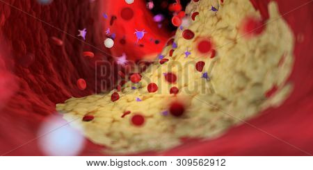 3d rendered medically accurate illustration of a capped plaque in a human artery