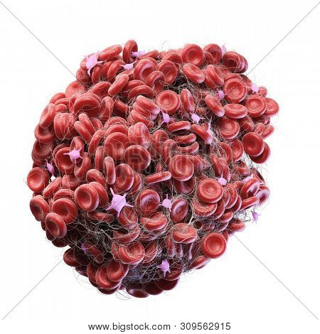 3d rendered medically accurate illustration of a blood clot