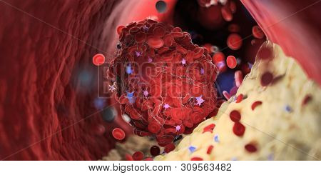3d rendered medically accurate illustration of a thrombus emerging from a capped plaque