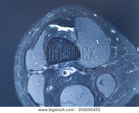 Knee Injury Mri Mcl Tear