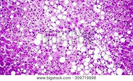 Histopathology Of Liver Steatosis, Or Fatty Liver. Light Micrograph, Photo Under Microscope