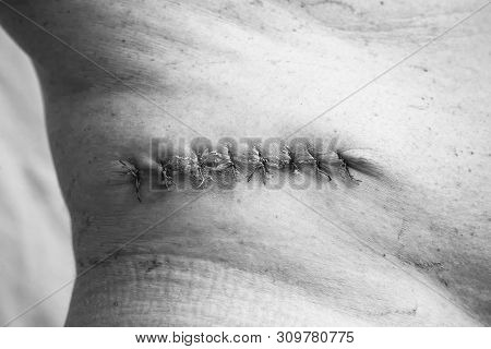 Department Of Oncology Surgery. A Picture Of A Postoperative Medical Suture After Removal Of A Malig