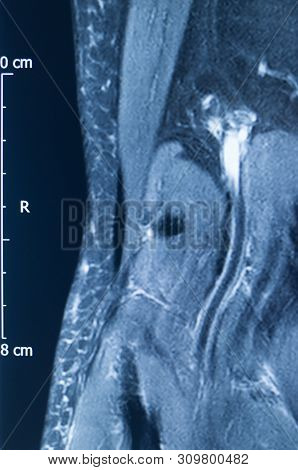 Knee Injury Mri Mcl Tear